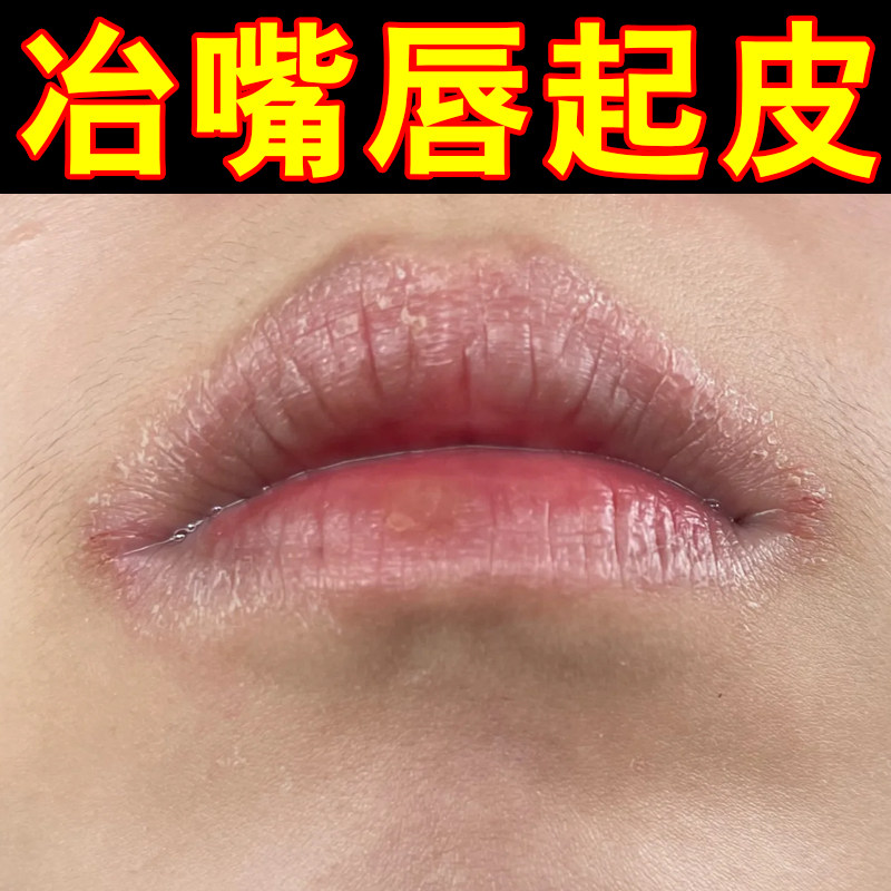 冶嘴唇干燥起皮的药唇周起小水泡干裂发痒脱皮修复嘴巴起皮补水膏