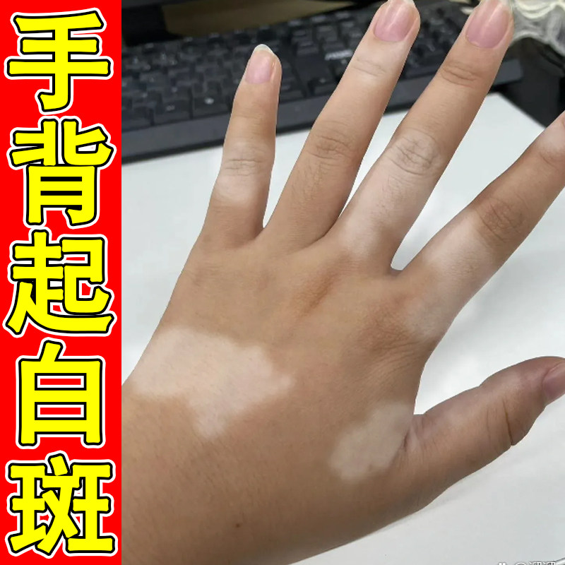 手背起白斑成人儿童小孩手上长汗斑花斑修复促进黑色素生长专用膏
