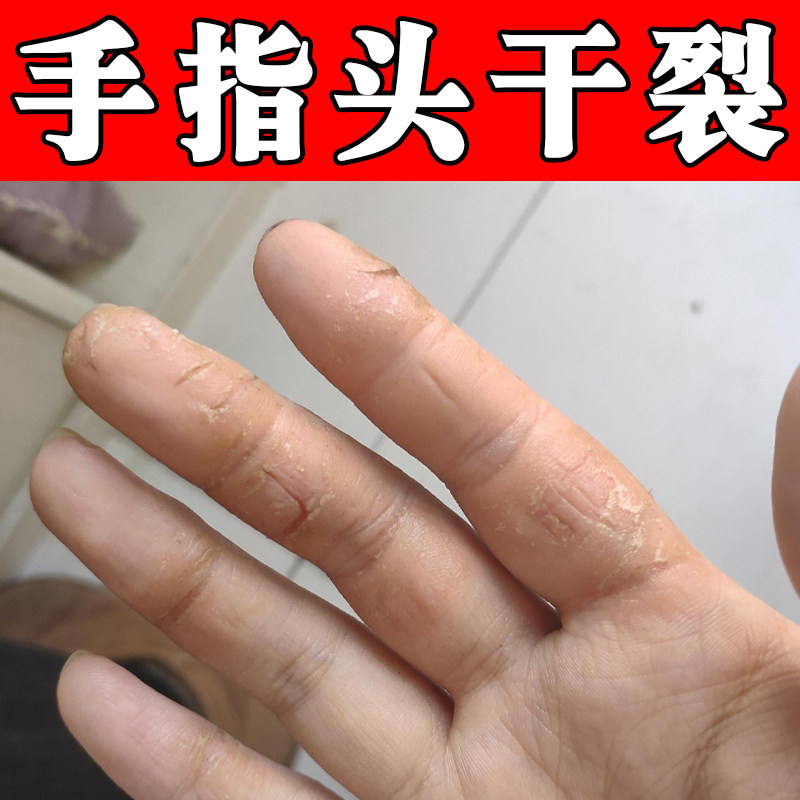 手指头干裂修复霜手部角质增厚粗糙多处裂口手起皮干燥粗糙脱皮药