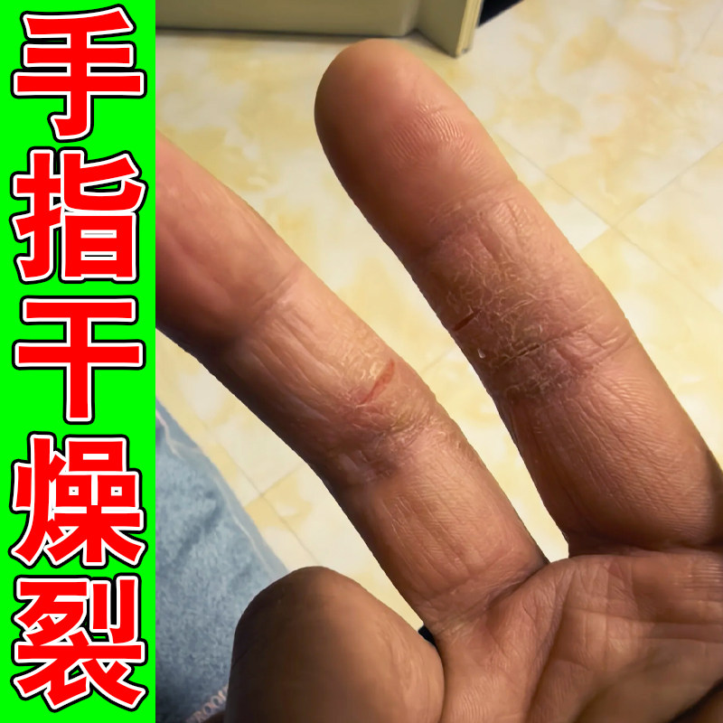 手指干燥裂口子换季手脱皮起皮脱屑粗糙脚后跟干裂修复霜手掉皮膏