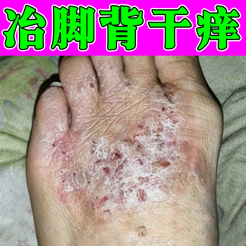 冶脚背干痒的药干燥粗糙起皮掉屑痒脚面长小红点疙瘩脱皮外用软膏