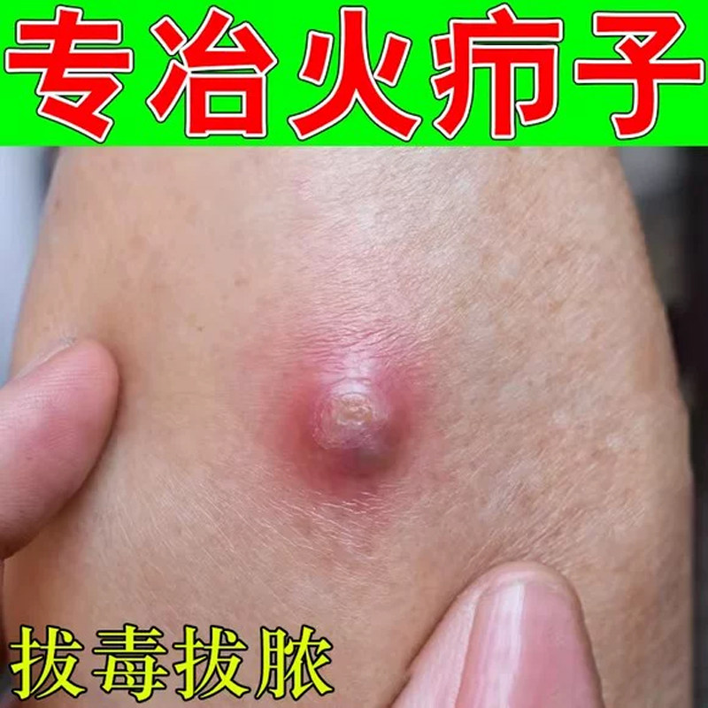 火疖子红肿块疙瘩专用膏脓包结节硬块痘疙瘩身上疖子疼痛痒外用药