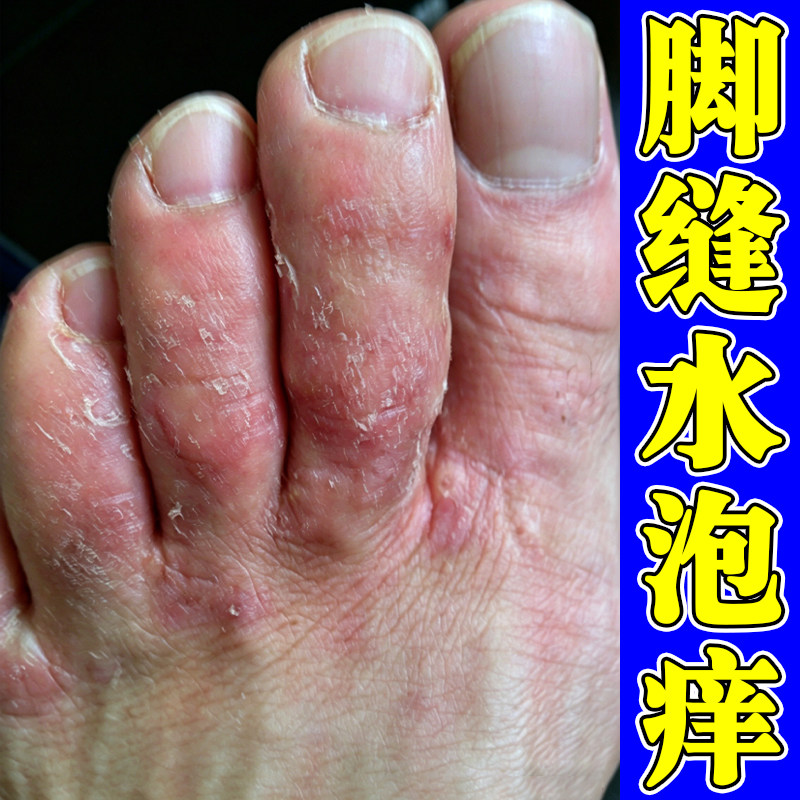 脚缝长小水泡潮湿痒外用修复夏天脚出汗脚痒脚趾缝脱皮软膏