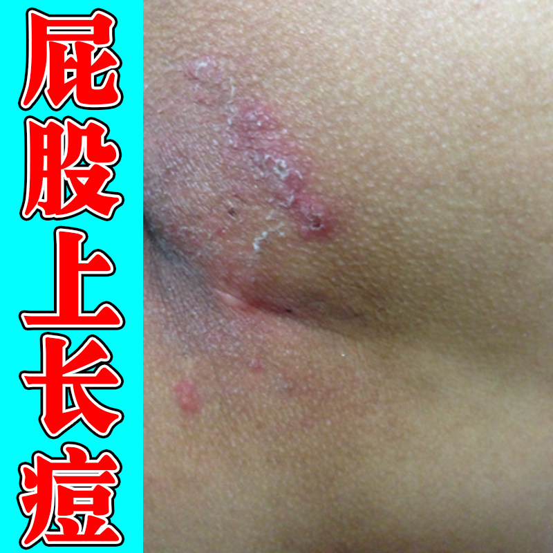 屁股上长痘痘起热疙瘩红斑干燥粗糙起皮掉屑臀部干痒大腿内侧痒药