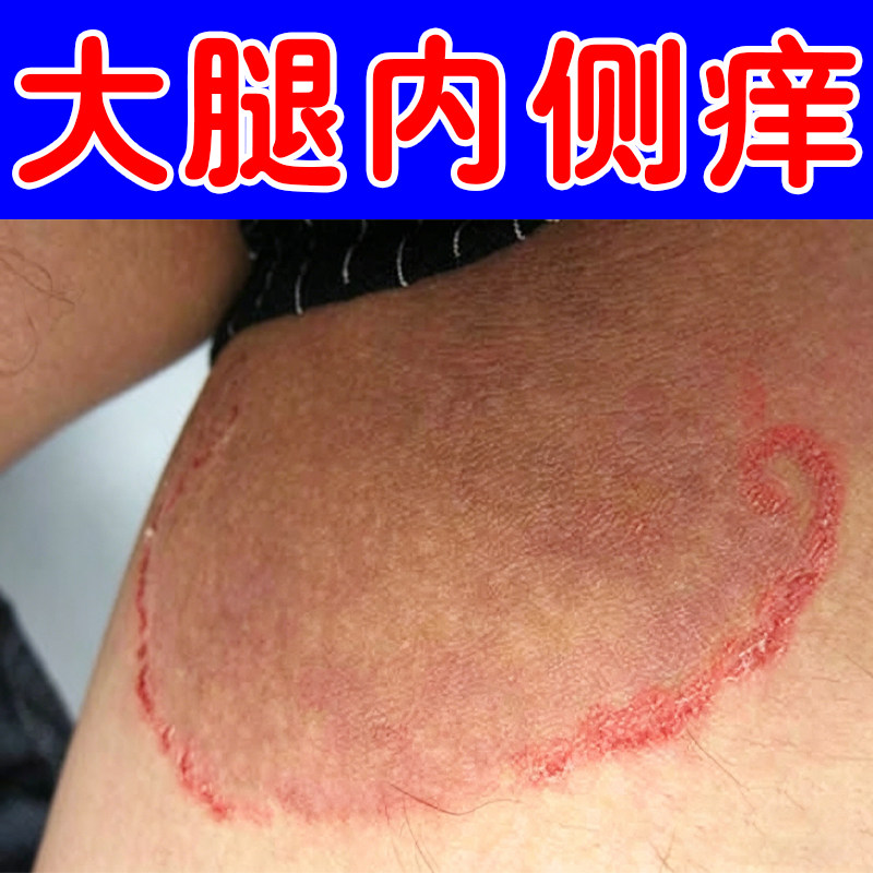 大腿内侧痒感染环状红斑干痒粗糙腿部两侧私处潮湿长红斑疙瘩痒膏 - 实物图