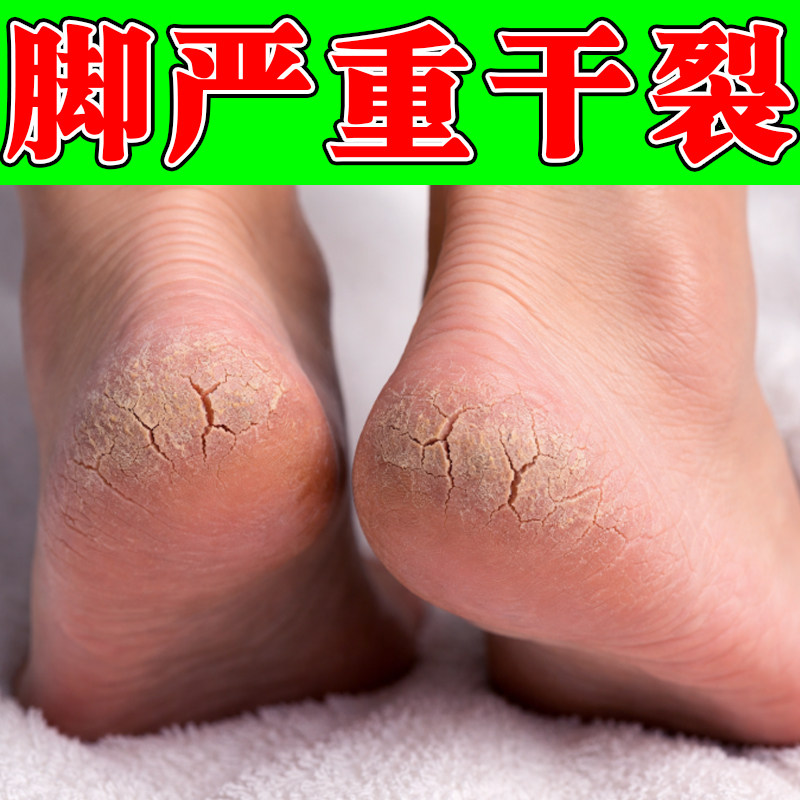 脚干燥粗糙起皮掉屑专用脚后跟干裂口子季节性手足脱皮起硬皮软膏