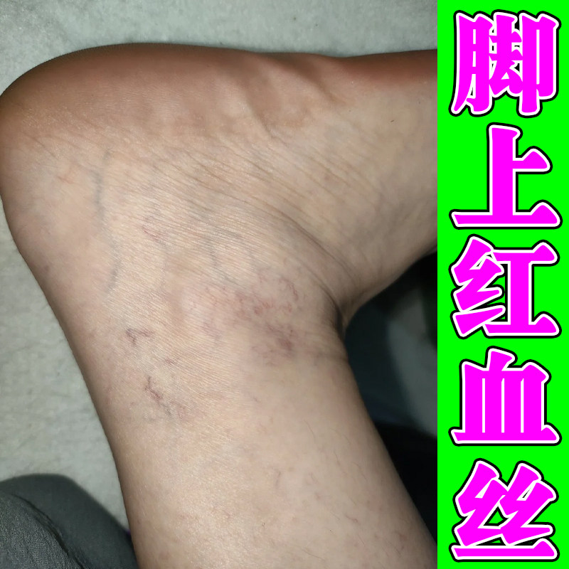 脚上红血丝血管不流通下肢酸胀毛细血管扩张青筋凸起男女血丝腿