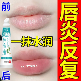 唇炎唇膏嘴巴红肿嘴唇上长疱疹干裂起皮起水泡红痒脱皮口周唇部炎