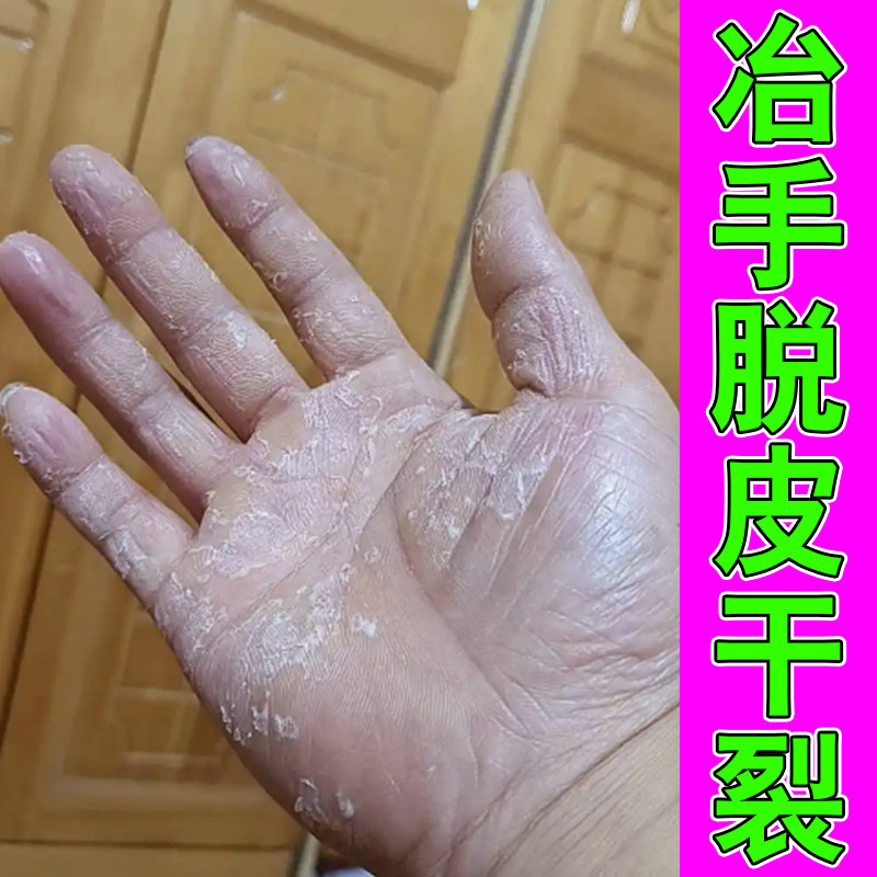 手脱皮严重手上皮肤感染过敏手部干燥起皮开裂口脱皮专用修护膏