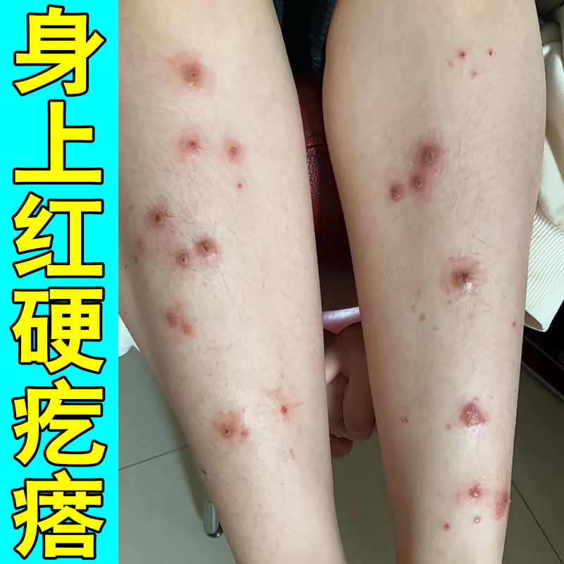 腿上硬疙瘩皮肤过敏红肿抓挠干燥专用草本乳膏腿上结节硬疙瘩发痒