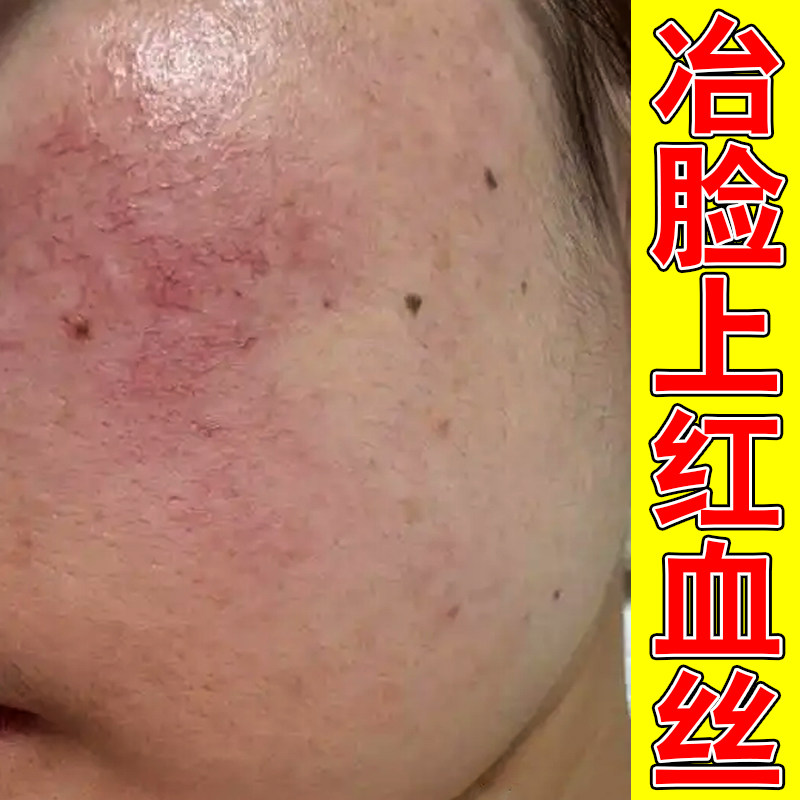 脸上的红血丝修复增厚角质层肌肤屏障受损修护皮肤红专用草本乳膏