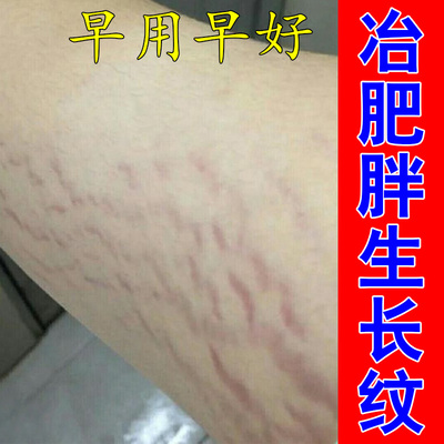 肥胖纹修复霜大腿生长纹专用肥胖纹生长纹修复霜大腿生长纹妊娠纹