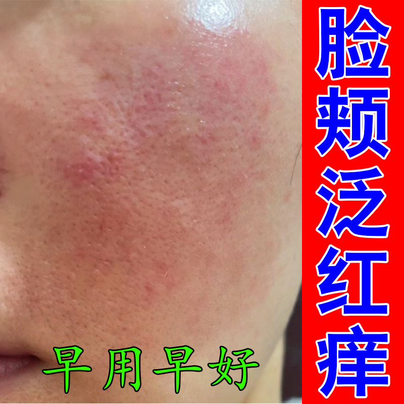冶脸上红血丝脸颊泛红脸部鼻翼两侧泛红皮肤痒敏感肌肤角质层增厚