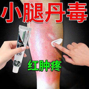 治丹毒膏皮肤红肿发热下肢丹淋巴水肿静脉炎止痛感染膏
