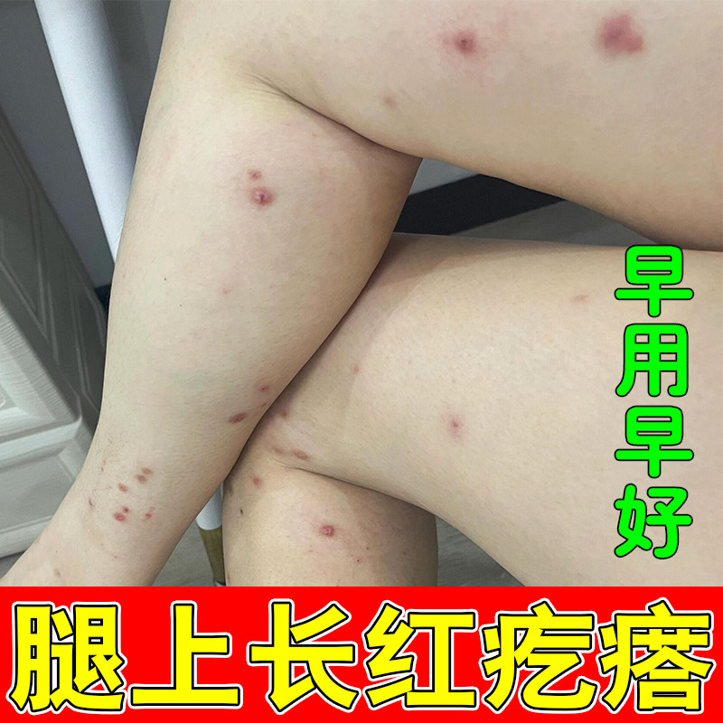 腿上长红硬疙瘩皮肤干燥粗糙发痒草本修护软膏小腿结硬节疙瘩发痒