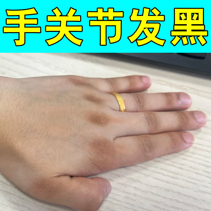 手指关节发黑痒手掌干燥粗糙手关节脖子发黑严重手上硬皮过敏干燥