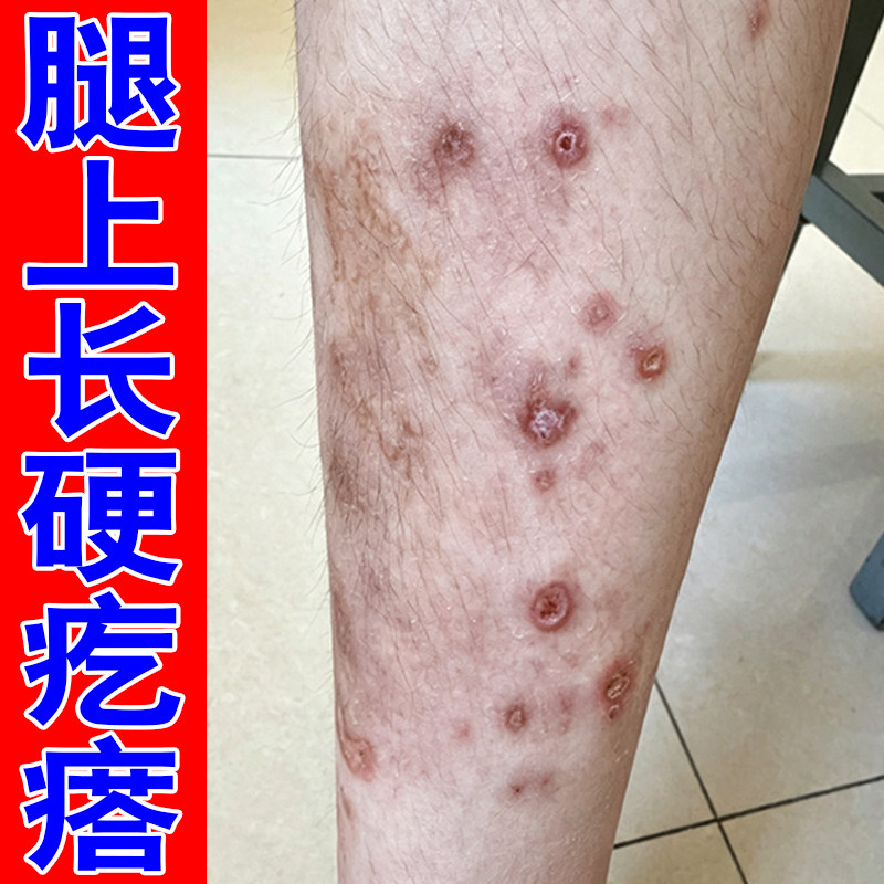 腿上长硬疙瘩发痒皮肤过敏干燥粗糙长硬块疙瘩全身皮肤红痒草本膏