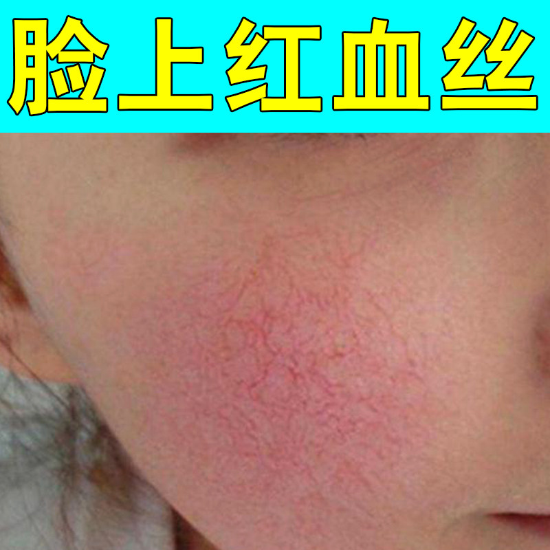 脸上长红血丝脸颊泛红脸颊过敏皮肤痒敏感肌泛红红血丝专用草本膏