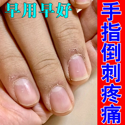 手指倒刺修复指甲边缘长肉刺皮肤干燥脱皮专用草本修护软膏