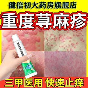 治疗寻荨麻疹过敏皮肤瘙痒止痒湿疹神经性皮炎抑菌抗过敏专用药膏
