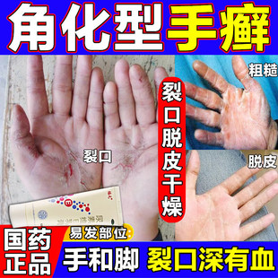 角化型手癣药膏脱皮脚后跟干裂真菌感染手粗糙增厚生尿素维E乳膏