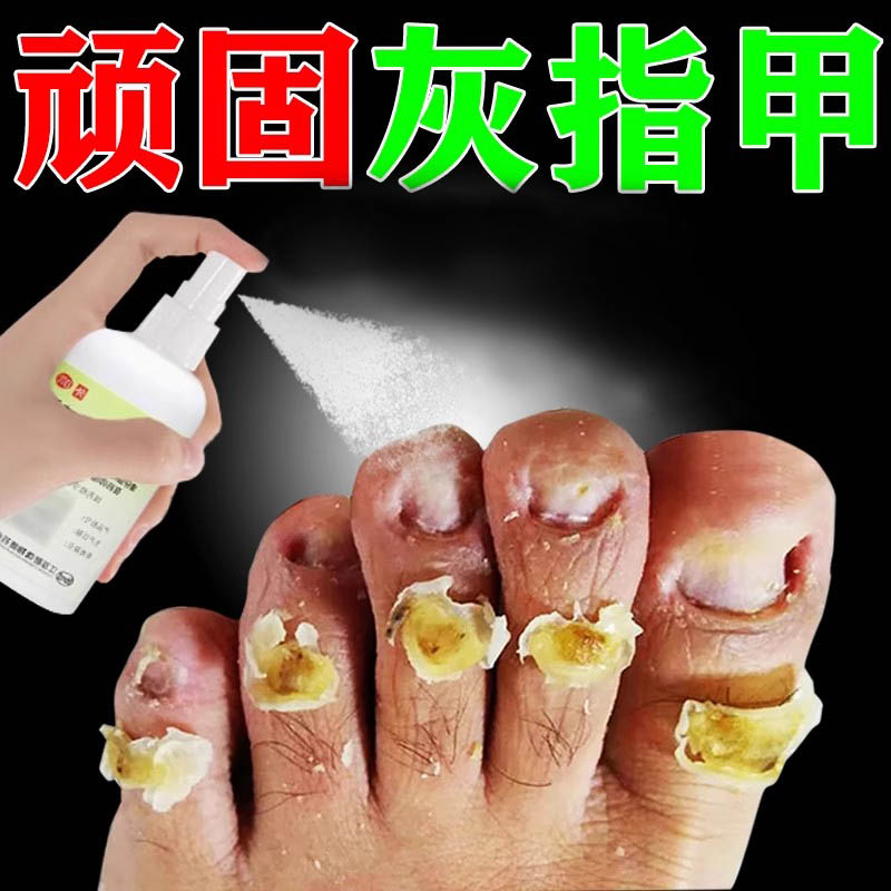 【齐鲁】盐酸特比萘芬喷雾剂1%*15ml*1瓶/盒