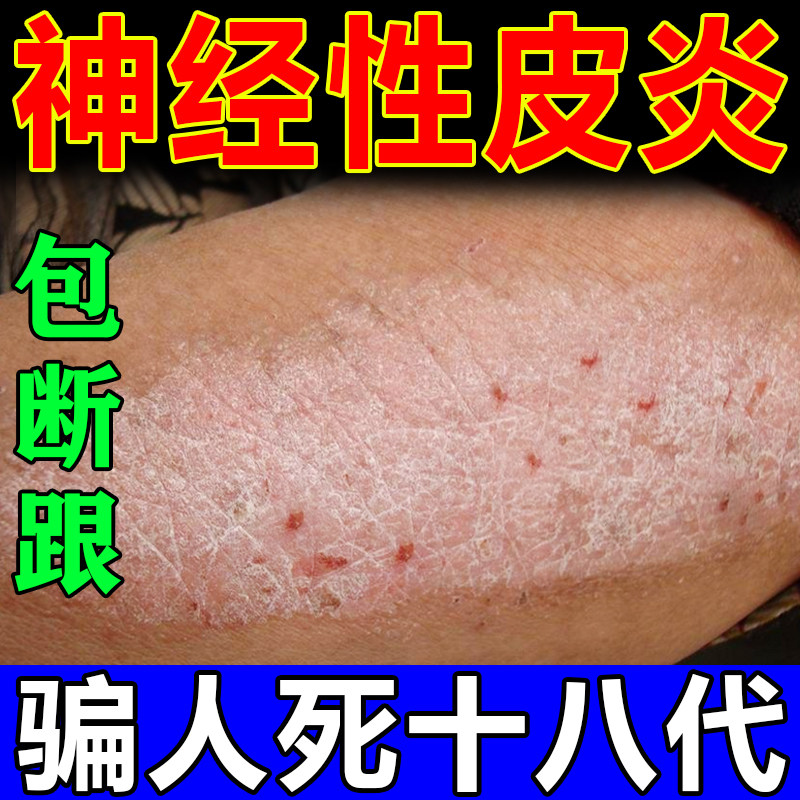 治疗神经性皮炎根去除外用膏顽固无激素皮肤藓真菌感染止痒药特效
