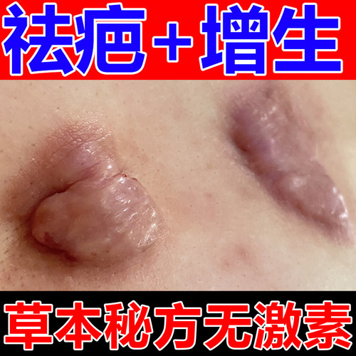 胸前瘢痕疙瘩增生凸起修复膏