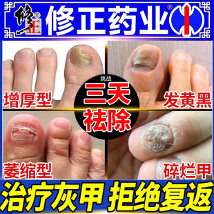 修正灰指甲专用药特效用药治根第1一名正品官方旗舰店甲沟炎真菌