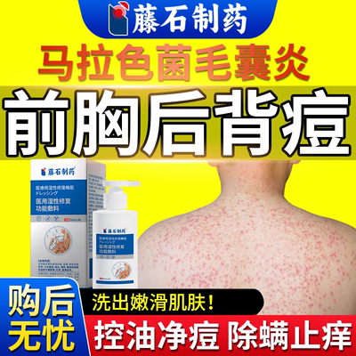 【速发】后背长痘毛囊炎除螨祛痘