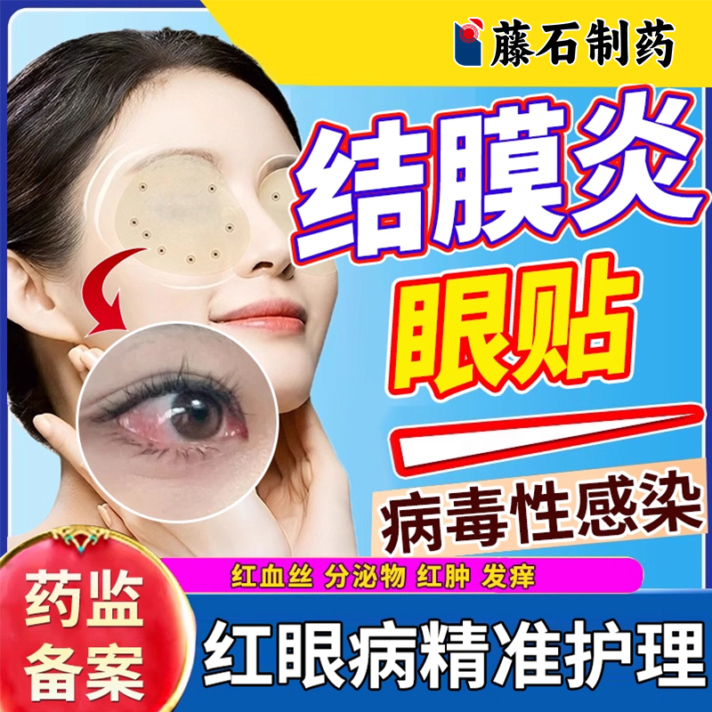 眼睛红血丝痛痒专用冷敷贴结膜炎