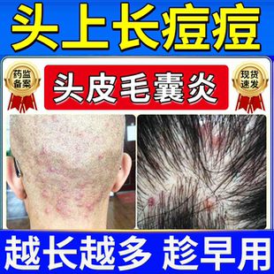 头皮头上长痘痘红疙瘩痒专用有特头癣毛囊炎效的喷雾剂药房同款JW