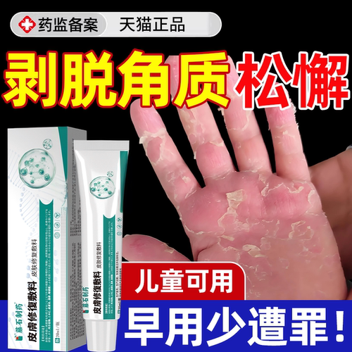 【速发】手脱皮剥脱角质松解症膏