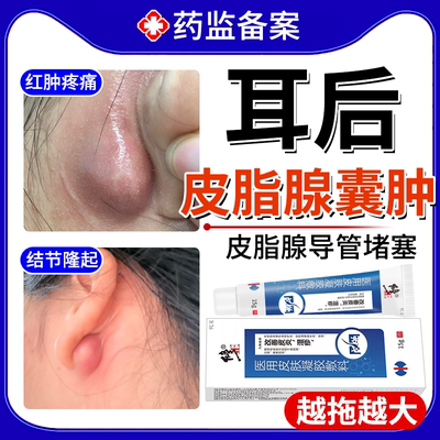【医用级】耳朵皮脂腺囊肿凝胶