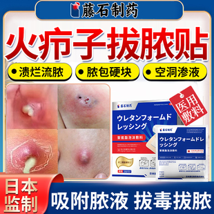 屁股上长火疖子敷料贴拔毒拔脓膏脸上疖肿术后硬块毛囊炎长痘痘YM