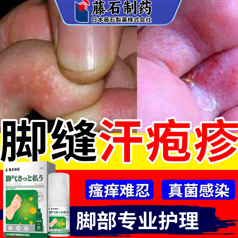 脚趾缝小水泡脚上汗泡疱疹膏汗状疱疹止痒汉状真菌感染药监备案ym