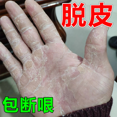 手脱皮严重脱皮专用药膏