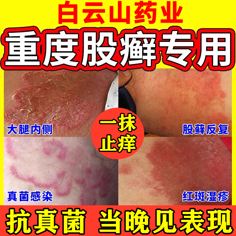 股癣专用药膏皮肤瘙痒皮炎湿疹真菌感染大腿内侧瘙痒股藓止痒药根