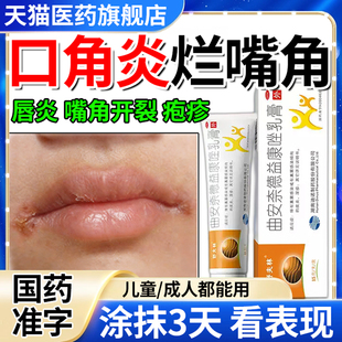 口角炎烂嘴角药膏嘴巴上火起泡专用唇炎嘴角开裂疱疹儿童干裂脱皮