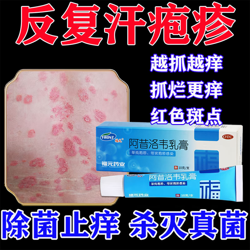 阿昔洛韦软膏乳膏正品汗疱疹特痒效药汗状疱疹专用皮肤感染药膏