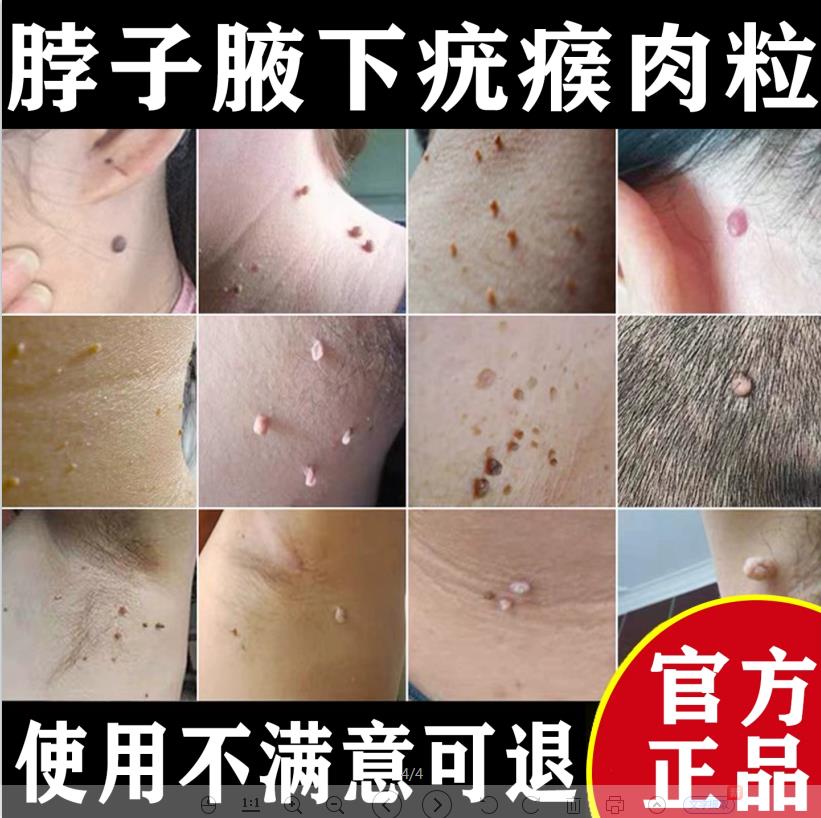 脖子腋下传染性丝状疣瘊子