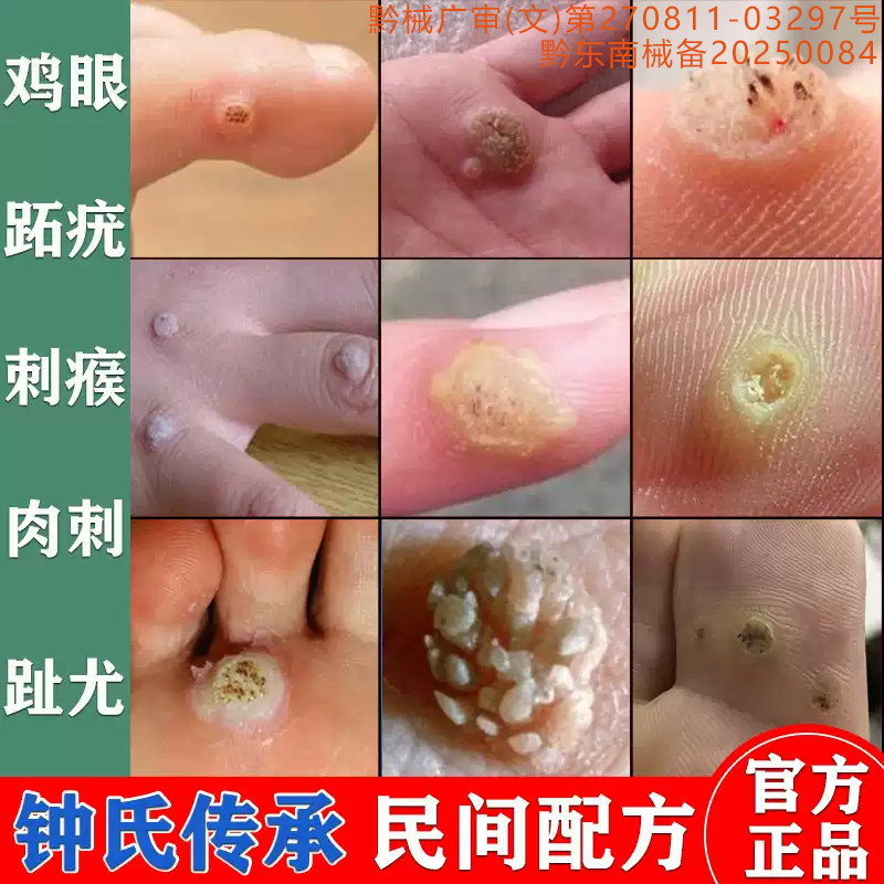 鸡眼膏去脚底鸡眼猴子跖疣鸡眼贴鸡贴眼膏手上刺猴肉刺专用去除膏