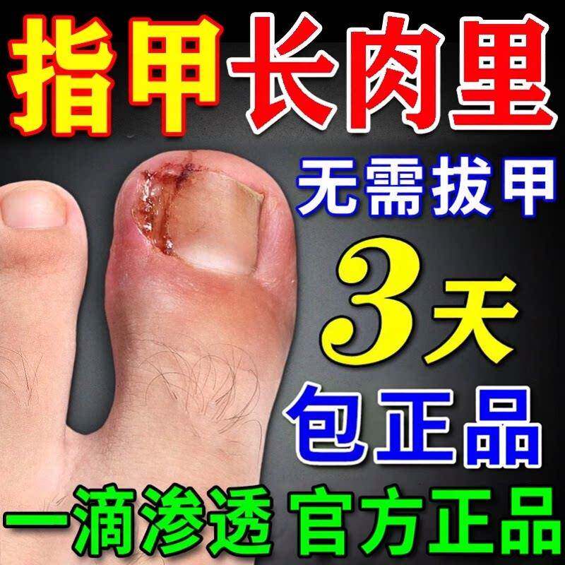 甲沟炎息肉去除专用膏药脚大拇指消肿退热凝胶去肉芽化脓软化剂