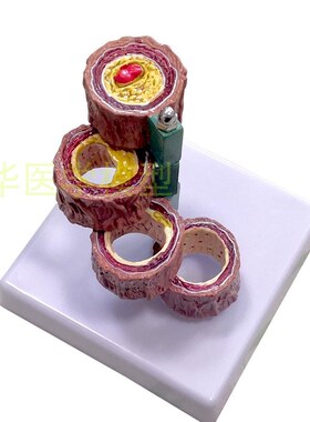 极速血管病e理 粥样硬化动脉模型 病变血栓/模型 人体病态血管演