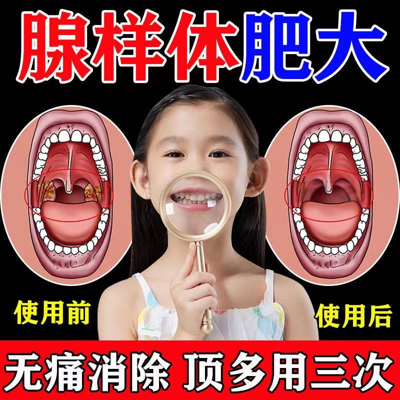 极速【无需手术】儿童腺样体肥大面容矫正改善儿童R口呼吸神器贴O