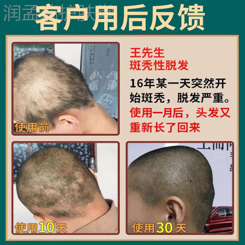 极速鬼剃发药斑秃生髪液脱发严A重女士增发密发斑脱男士防脱生髪