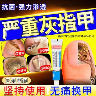 环吡酮胺药膏专治疗去灰指甲专用药膏脱甲除真菌感染手脚甲沟炎