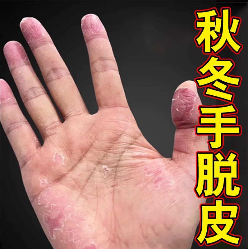 专冶手长手指起干皮脚手起皮软膏皮肤消毒护理（消）