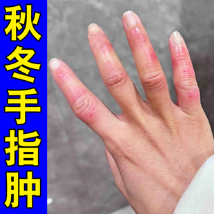 手上长冻疮红肿干燥脱皮冬天冷耳朵手足脸部防冻伤防冻裂修复膏