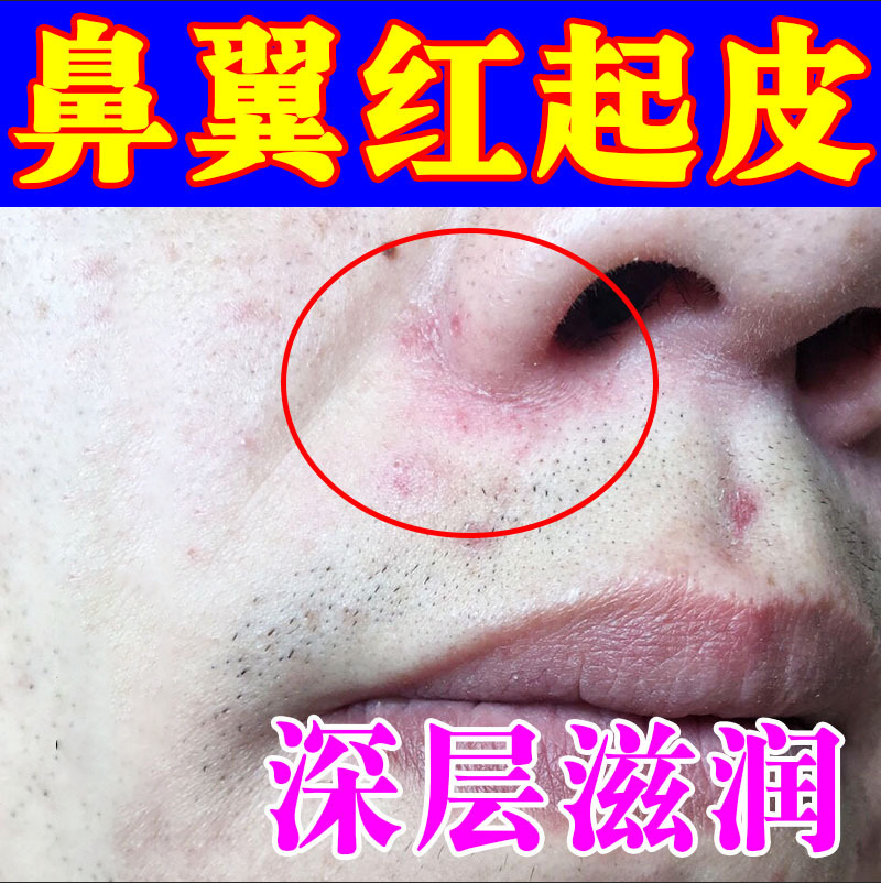 鼻子两侧发红痒脱皮脂溢性皮炎鼻翼两边泛红干燥起皮红痒痘痘